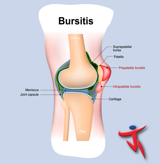 Illustration of knee with bursa pockets inflamed to show bursitis.