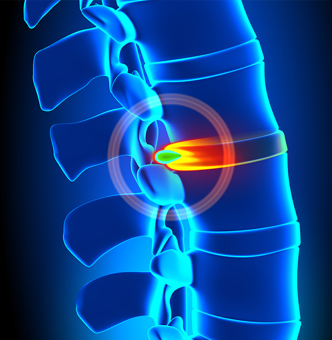 Illustration of a herniated disc protruding.