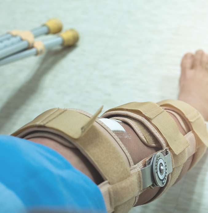 Picture of knee brace and crutches on a post-surgical patient.