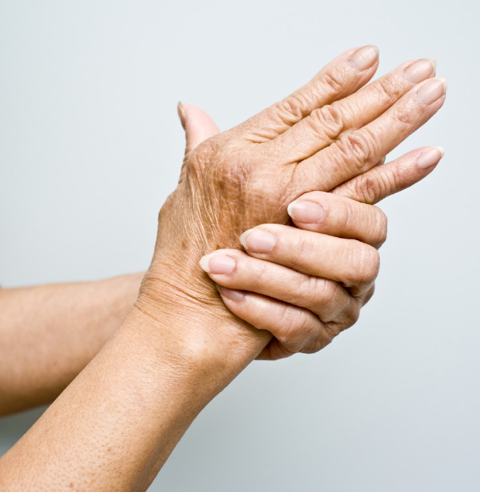 Picture of arthritic hand